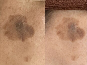 リシア(RECIA)/大きなシミもここまで薄くなる◎