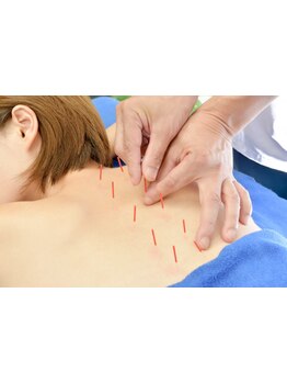 鍼灸施術を受けたい