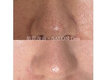 毛穴の気になる肌も毛穴から肌質改善を実感♪小顔・透明感もUP◎