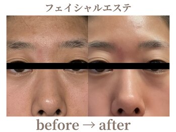 サロンラペーシュ(Lapeche)/フェイシャル befor→after