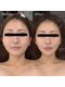 ヴィノ(VINNO)の写真/「え、一回で!?」ラジオ波×電気のWアプローチで驚きの小顔へ