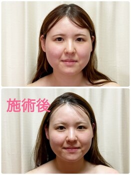 マジーブランシュ/施術後は別人？？！