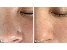 フーラ バイ アングラーズ(fu-ra by ANGLERS)/【光フェイシャル】毛穴ケア