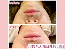 アメリイ 百合ヶ丘 新百合ヶ丘(Amerii)/ハーブピーリング/ニキビ/毛穴