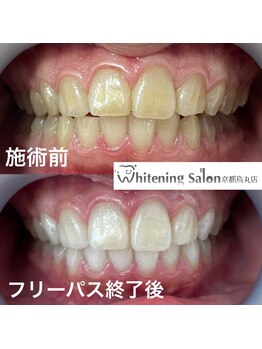 ホワイトニングサロン 京都烏丸店/ホワイトニング施術例