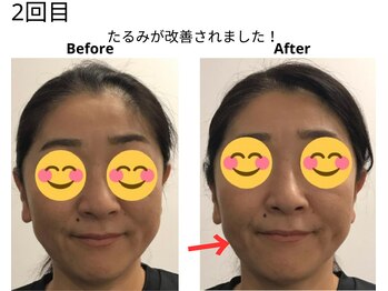 ベル/50代の方の小顔Before After