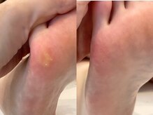 キラネイル アンド アイラッシュ by World Beauty(KIRA)/フット角質除去