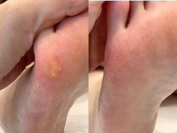 キラネイル アンド アイラッシュ by World Beauty(KIRA)/フット角質除去