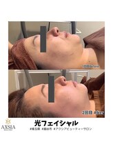 アクシア ビューティー サロン(AXSIA)/【光フェイシャル】BeforeAfter