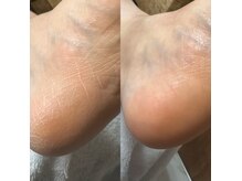 冬対策にオススメ◎乾燥、カサツキ足裏の角質、魚の目ケア！