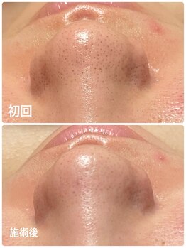 ヴィヴィエ 佐賀店(ViVier)/毛穴ケア