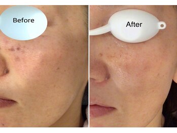 シェアキ(Chez Aki)/シミケアBefore/After