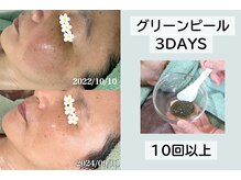 ルーチェ(LUCE)の雰囲気（日本で貴重な最高級ハーブピーリング◎シミトラブルにも♪）