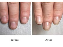 アンベリール(embellir.)/自爪・深爪育成