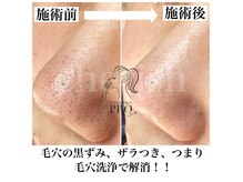 チェリッシュ(Cherish)の雰囲気（毛穴エクストラクションプロでお悩み解決！毛穴洗浄）