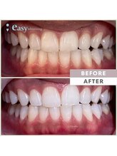 イージーホワイトニング 神戸三宮店(easy whitening)/お客様の症例写真です★