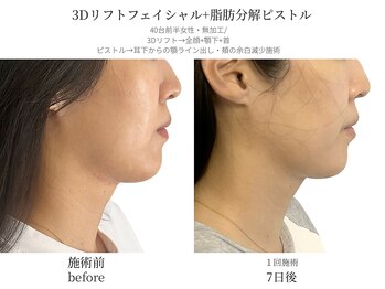 サボラミ(sabor A Mi)/リフトアップと脂肪分解W施術☆
