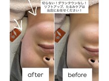 サロン エミリー(Salon Emily)の雰囲気（圧倒的！ダウンタイムなしで口元ポニョ、二重アゴ撃退！輪郭造形）