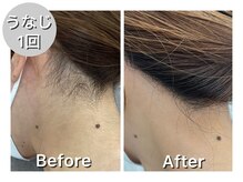 ナルシス/【うなじ&背中脱毛】1回の変化★