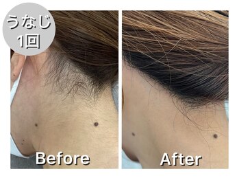 ナルシス/【うなじ&背中脱毛】1回の変化★