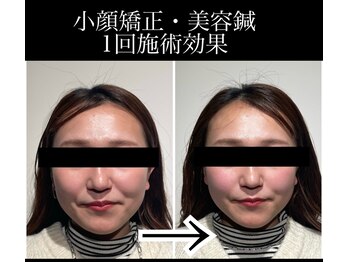 ユウサク(Yusaku)/30代症例【小顔矯正/本町/梅田】