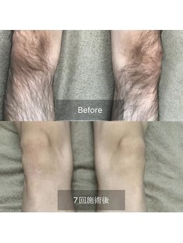 カルナ(CARNA)/ひざ下脱毛（7回施術）
