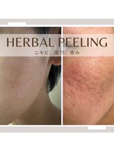 ジュノー ビューティー 綾瀬店(Juno Beauty)/毛穴/ハーブピーリング/エステ