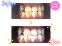 エクシアホワイト 倉吉店(ecxia white)/ビフォーアフター