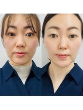 トゥインクル(Twinkle)/傷つけず育てるフェイシャル