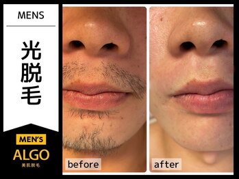 アルゴ 敦賀店(ALGO)/20代男性６回目　髭WAX脱毛