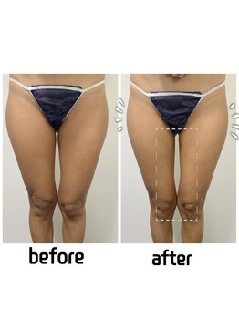 エクスクラメーションマーク(!!!)/ボディー