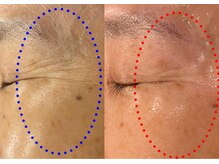 セブンシーズ 上野店(Seven Seas)/【効果比較】施術前後の並び比較