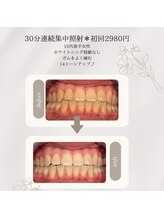 プラスビーセルフ(+b self)/ホワイトニングビフォーアフター