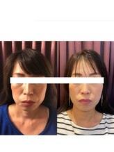 長寿鍼灸院 長寿整骨院/美容鍼50本の効果★ハリ・ツヤ