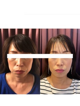 長寿鍼灸院 長寿整骨院/美容鍼50本の効果★ハリ・ツヤ