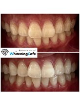 ホワイトニングカフェ 南草津店/4回コース症例写真