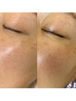 ブリス(Bliss)/グランACトリートメント1回