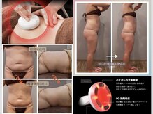 【全身がり痩せスリムムーヴ】温め×吸引、効率的に燃焼