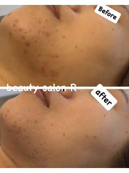ビューティサロン アール(R)/ニキビ改善