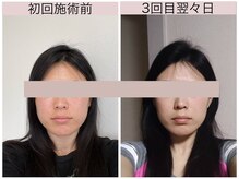 プランドール/「シュッとした小顔になりたい」