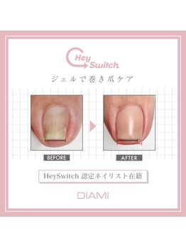 日本初上陸！韓国発祥巻き爪ケア