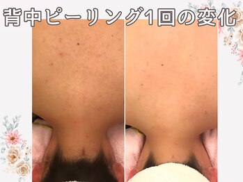 マリスステラ 天王寺(MarisStella)/背中ピーリングの変化