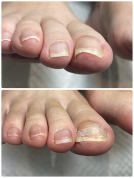 ドクターネイル爪革命 所沢西店/巻き爪［所沢/狭山ヶ丘］