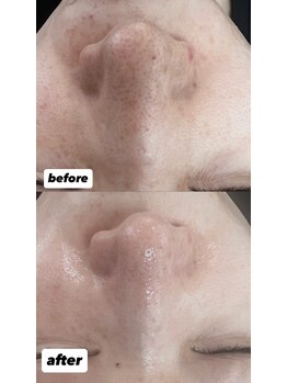ルアナ(Ruana)の写真/毛穴洗浄＆黒ずみケアで、気になる毛穴ざらつきスッキリ！理想のツルスベ美肌を目指しましょう☆
