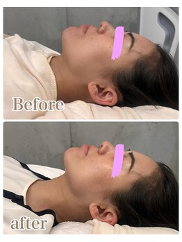 エトア 中目黒(ETOA)/フェイスラインのもたつきに◎