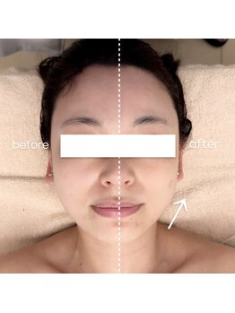 オルネ(ORNE.)の写真/【最新引き締めマシンで気になる箇所を狙い撃ち】顔全体を引き上げて年齢によるたるみ・歪みを改善！