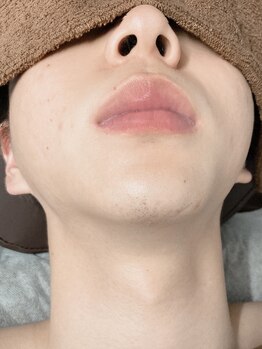 ヴィプラス(VIPLUZ)/髭脱毛