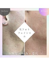 バーグトータルビューティー(bague total beauty)/光フェイシャル/ニキビケア