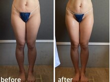 リジュ(Reju)/大人気！ハイパーナイフEX痩身！