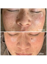 マイルーチェ 可児川合店(MyLuce)/純粋レチノールピール6回施術